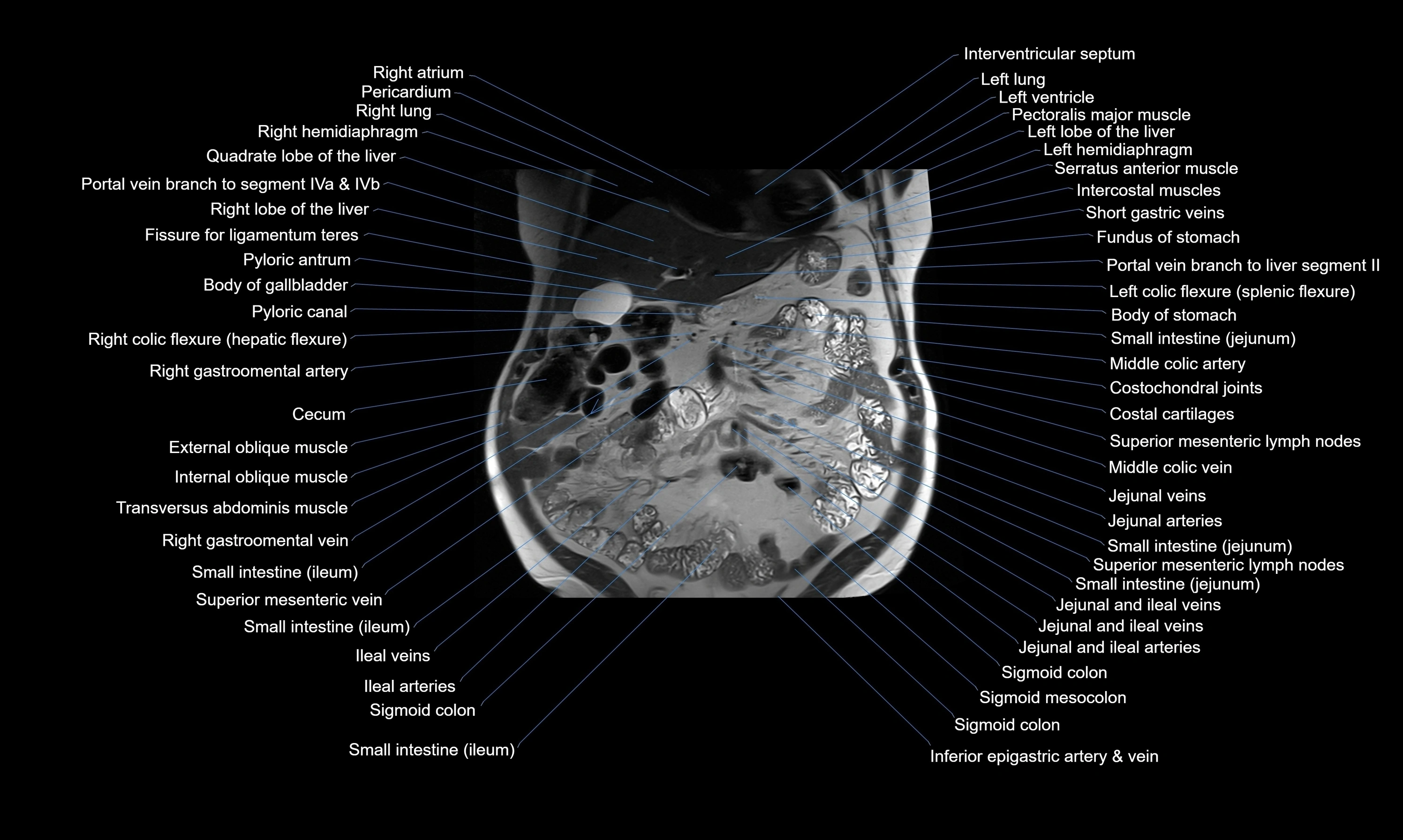 MRI Abdomen axial cross sectional anatomy radiology  image-img-00001-00021.webp